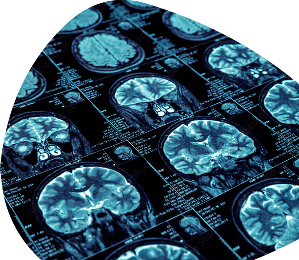 Brain MRI/MRA and AI Overread